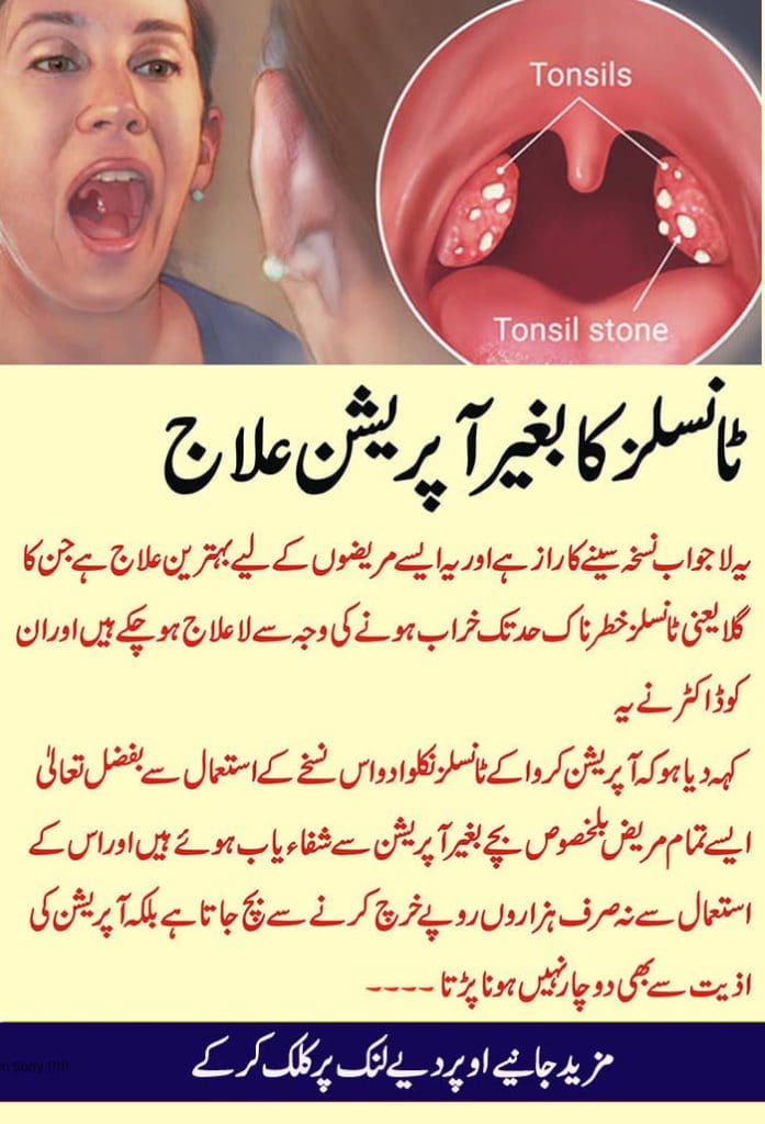 What are Tonsils: Get Rid of Tonsils by Natural Home Remedies | Daily